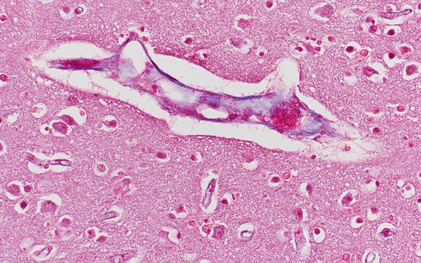 1G Mycoplasma Leukoencephalitis (Case 1) N1 Trichrome