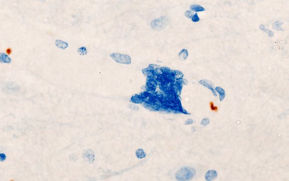 1H1 Mycoplasma Leukoencephalitis (Case 1) N1 CD61 1