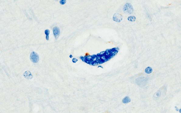 1H2 Mycoplasma Leukoencephalitis (Case 1) N1 CD61 3