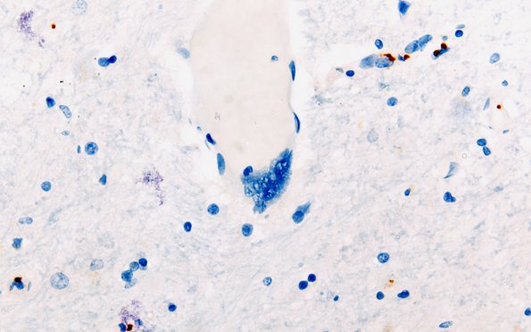 1H3 Mycoplasma Leukoencephalitis (Case 1) N4 CD61 2