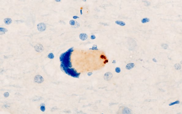 1H4 Mycoplasma Leukoencephalitis (Case 1) N4 CD61 3