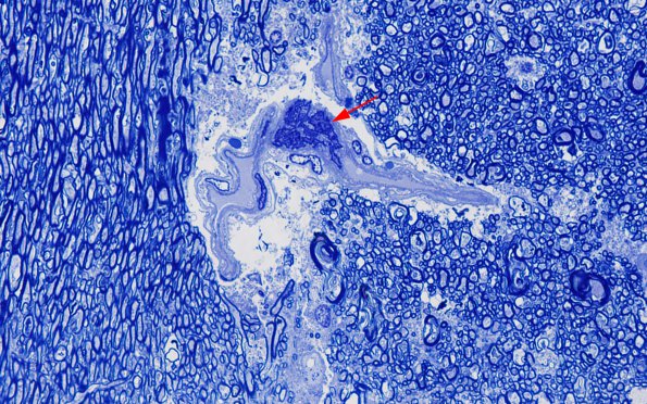 1I1 Mycoplasma Leukoencephalitis (Case 1) N7 Block A Plastic 13 copy