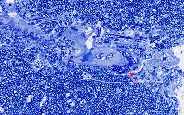 1I2 Mycoplasma Leukoencephalitis (Case 1) N7 Block B Plastic 100X 1 copy