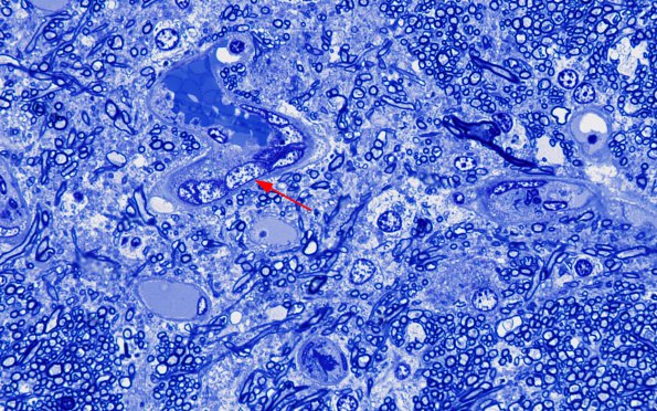 1I3 Mycoplasma Leukoencephalitis (Case 1) N7 Block B Plastic 100X 2 copy