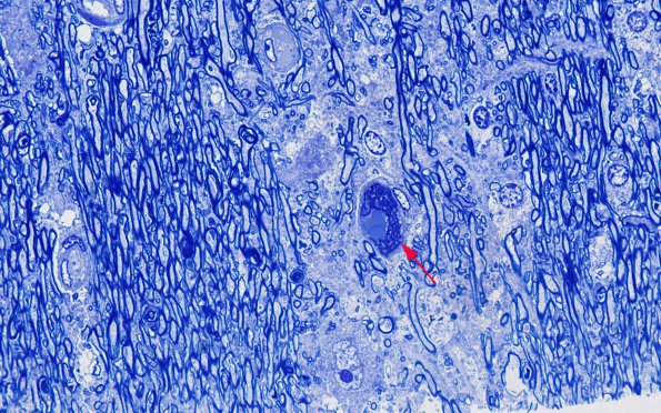 1I4 Mycoplasma Leukoencephalitis (Case 1) N7 Block A Plastic 14 copy