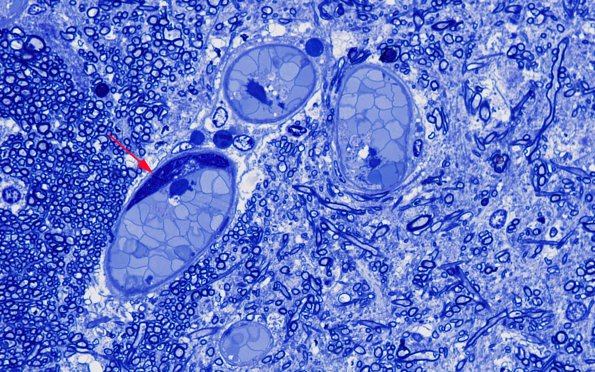 1I5 Mycoplasma Leukoencephalitis (Case 1) N7 Block B Plastic 100X 3 copy