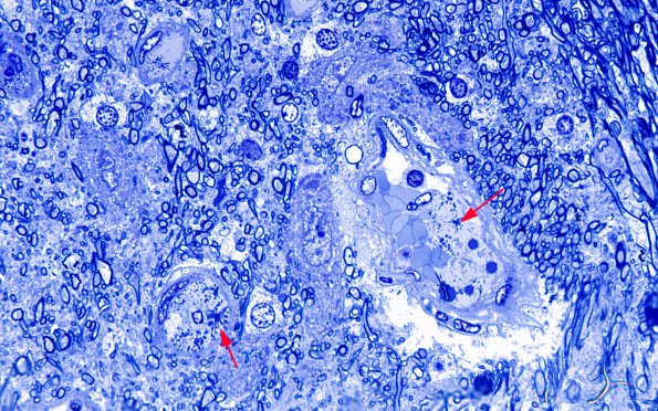 1I6 Mycoplasma Leukoencephalitis (Case 1) N7 Block A Plastic 10 copy