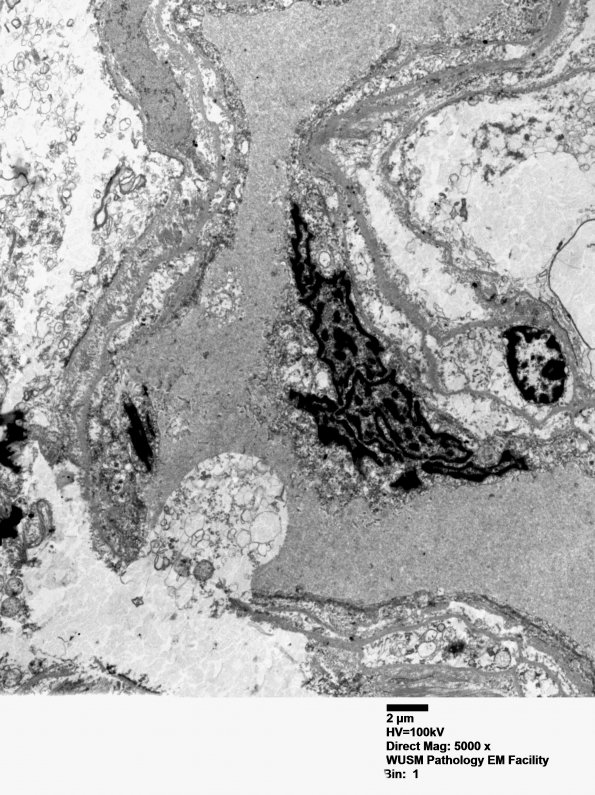 1J1 Mycoplasma (Case 1) EM 006 - Copy