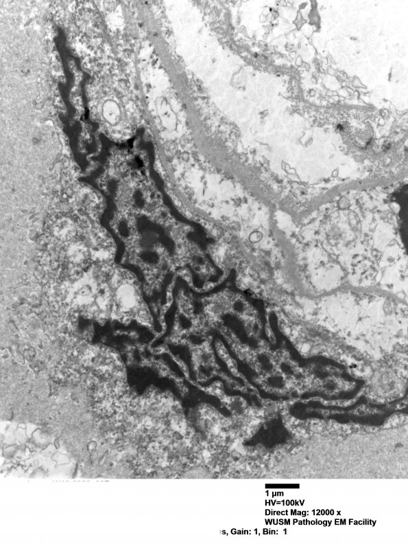 1J2 Mycoplasma (Case 1) EM 007 - Copy