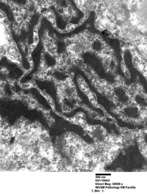 1J3 Mycoplasma (Case 1) EM 008 - Copy