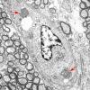 1J4 Mycoplasma (Case 1) EM 018 - Copy copy