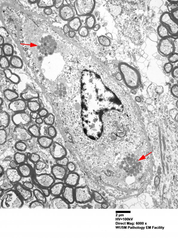 1J4 Mycoplasma (Case 1) EM 018 - Copy copy