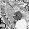 1J5 Mycoplasma (Case 1) EM 019 - Copy