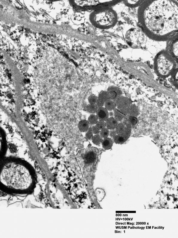 1J5 Mycoplasma (Case 1) EM 019 - Copy