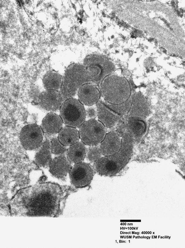 1J6 Mycoplasma (Case 1) EM 020 - Copy