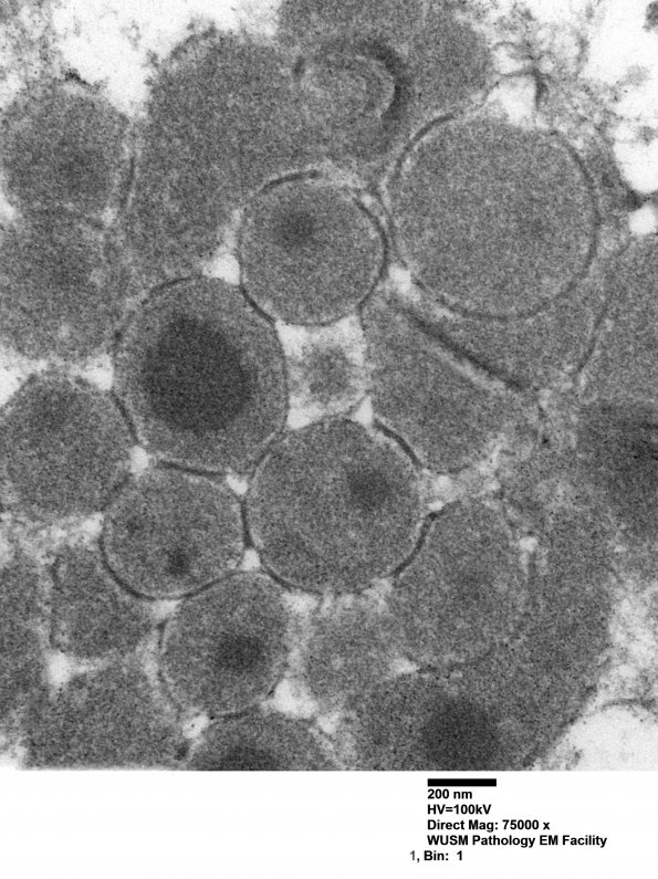 1J7 Mycoplasma (Case 1) EM 021 - Copy