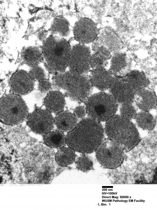 1J8 Mycoplasma (Case 1) EM 024 - Copy