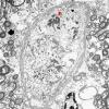 1J9 Mycoplasma (Case 1) EM 004 - Copy copy