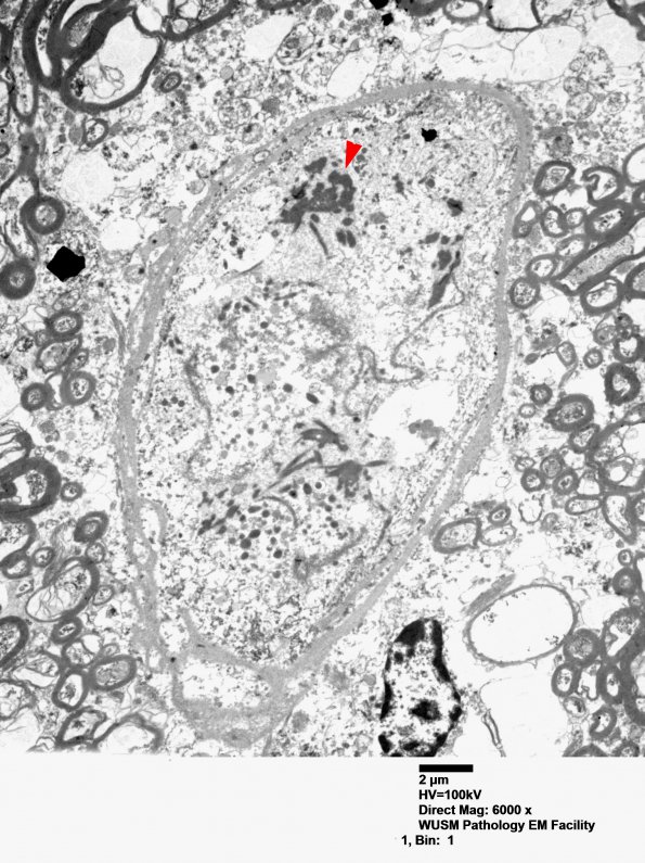 1J9 Mycoplasma (Case 1) EM 004 - Copy copy