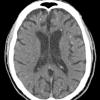 2A2 Mycoplasma Vasculopathy Leukoencephalopathy (Case 2) CT 2 - Copy