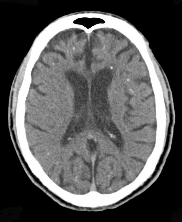 2A2 Mycoplasma Vasculopathy Leukoencephalopathy (Case 2) CT 2 - Copy