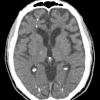 2A3 Mycoplasma Vasculopathy Leukoencephalopathy (Case 2) CT 3 - Copy