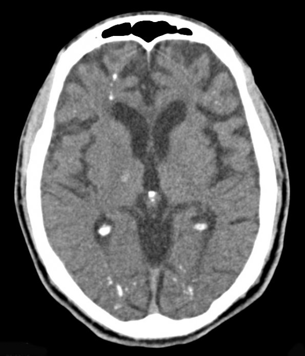 2A3 Mycoplasma Vasculopathy Leukoencephalopathy (Case 2) CT 3 - Copy