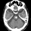 2A5 (Case 2)  CT 10-3-2012 CT 14of34 2