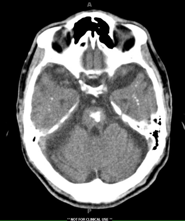 2A5 (Case 2)  CT 10-3-2012 CT 14of34 2