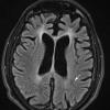 2B1 Mycoplasma Vasculopathy Leukoencephalopathy (Case 2)  FLAIR - Copy copy