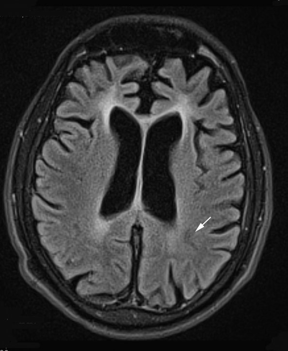 2B1 Mycoplasma Vasculopathy Leukoencephalopathy (Case 2)  FLAIR - Copy copy