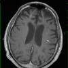 2B2 Mycoplasma Vasculopathy Leukoencephalopathy (Case 2)  T1 W - Copy copy