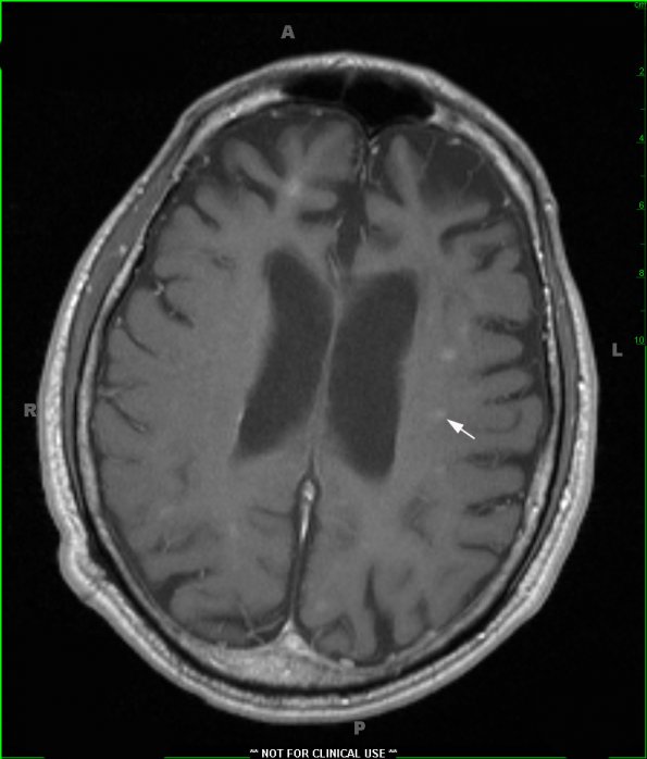 2B2 Mycoplasma Vasculopathy Leukoencephalopathy (Case 2)  T1 W - Copy copy