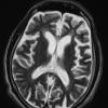 2B3 Mycoplasma Vasculopathy Leukoencephalopathy (Case 2)  T2 W - Copy