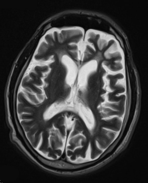 2B3 Mycoplasma Vasculopathy Leukoencephalopathy (Case 2)  T2 W - Copy