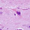 2C1 Mycoplasma Vasculopathy Leukoencephalopathy (Case 2)  H&E 100X 2