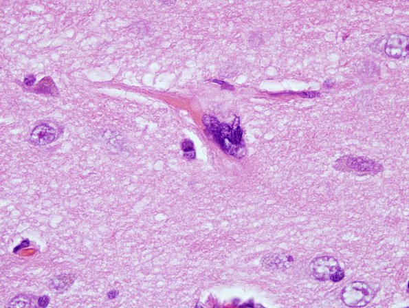 2C1 Mycoplasma Vasculopathy Leukoencephalopathy (Case 2)  H&E 100X 2