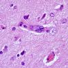 2C2 Mycoplasma Vasculopathy Leukoencephalopathy (Case 2) H&E 100X 6