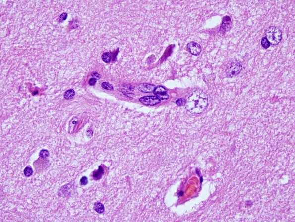 2C2 Mycoplasma Vasculopathy Leukoencephalopathy (Case 2) H&E 100X 6