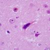 2C3 Mycoplasma Vasculopathy Leukoencephalopathy (Case 2)  H&E 100X 9