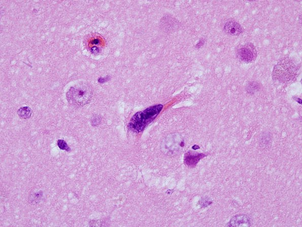 2C3 Mycoplasma Vasculopathy Leukoencephalopathy (Case 2)  H&E 100X 9