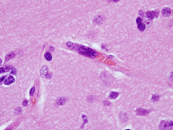 2C4 Mycoplasma Vasculopathy Leukoencephalopathy (Case 2)  H&E 100X 12