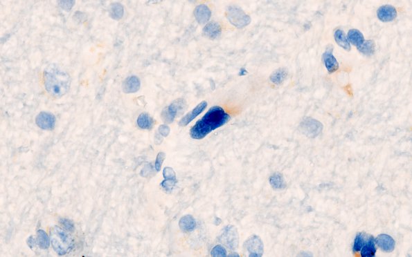 2D1 Mycoplasma Vasculopathy Leukoencephalopathy (Case 2)  CD20 100X 2