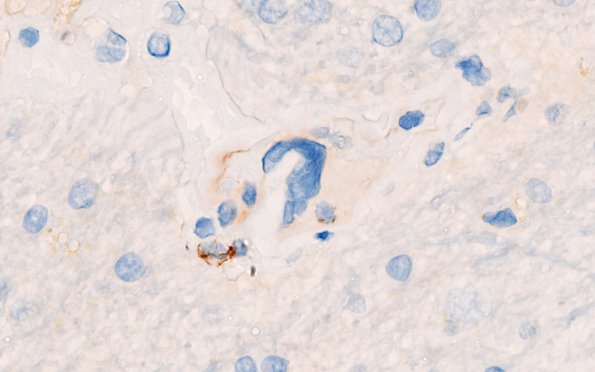 2D2 Mycoplasma Vasculopathy Leukoencephalopathy (Case 2) CD20 100X