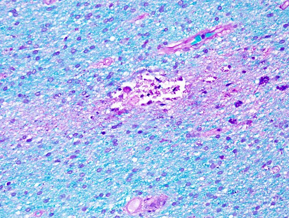 2E2 Mycoplasma Vasculopathy Leukoencephalopathy (Case 2) LFB-PAS 1