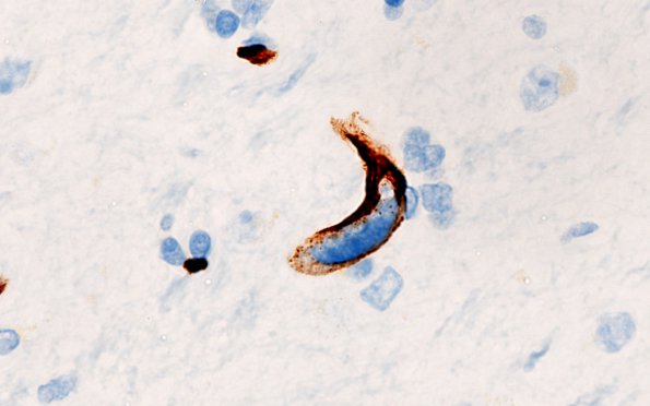2F3 Mycoplasma Vasculopathy Leukoencephalopathy (Case 2) CD34 100X