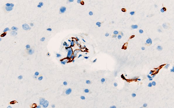 2F5 Mycoplasma Vasculopathy Leukoencephalopathy (Case 2) CD34 60X