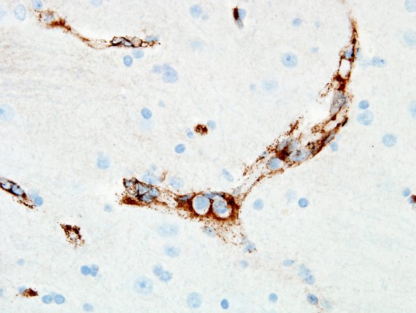 2G1 Mycoplasma Vasculopathy Leukoencephalopathy (Case 2) Factor VIII 1