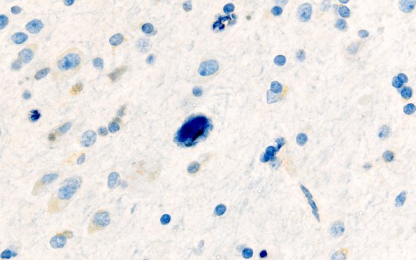 2H Mycoplasma Vasculopathy Leukoencephalopathy (Case 2) Ki67 3