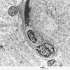 2I1 Mycoplasma Vasculopathy Leukoencephalopathy (Case 2) EM 1 - Copy